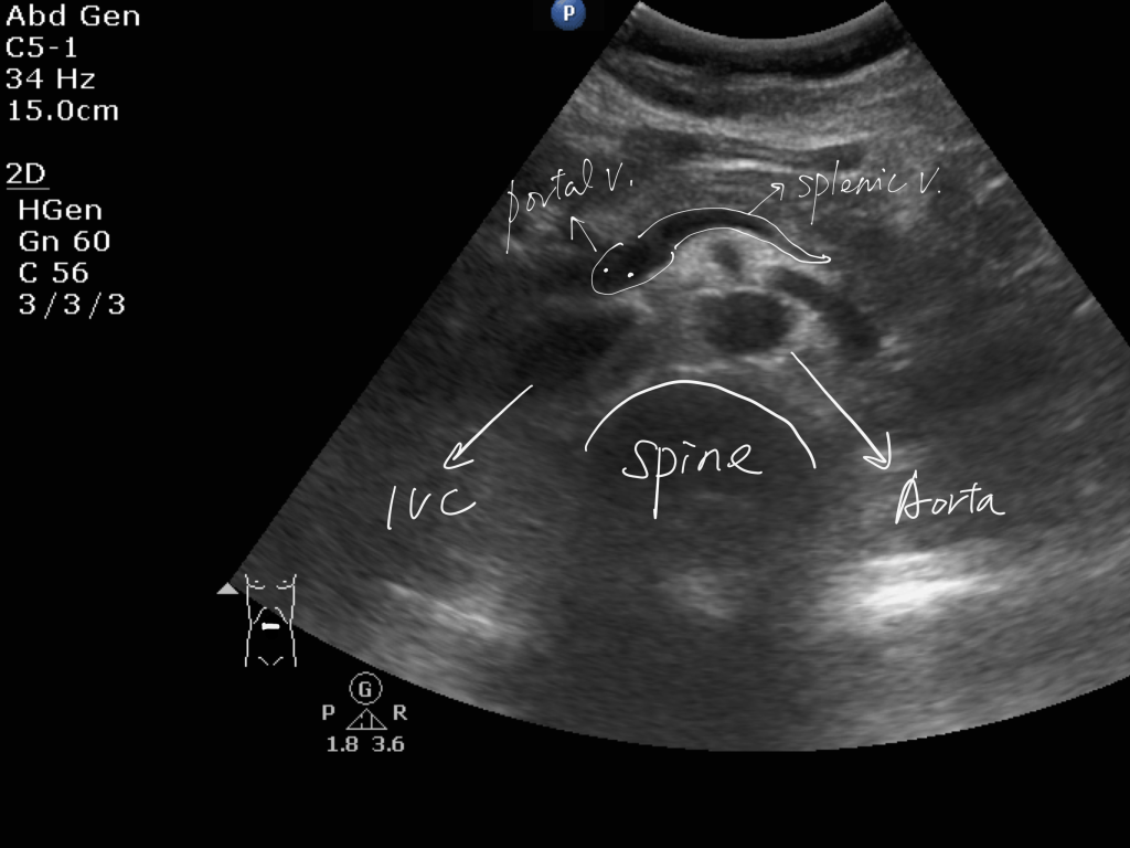 [Sonoanatomy] Pancreas, splenic vein, SMV – POCUS Academy