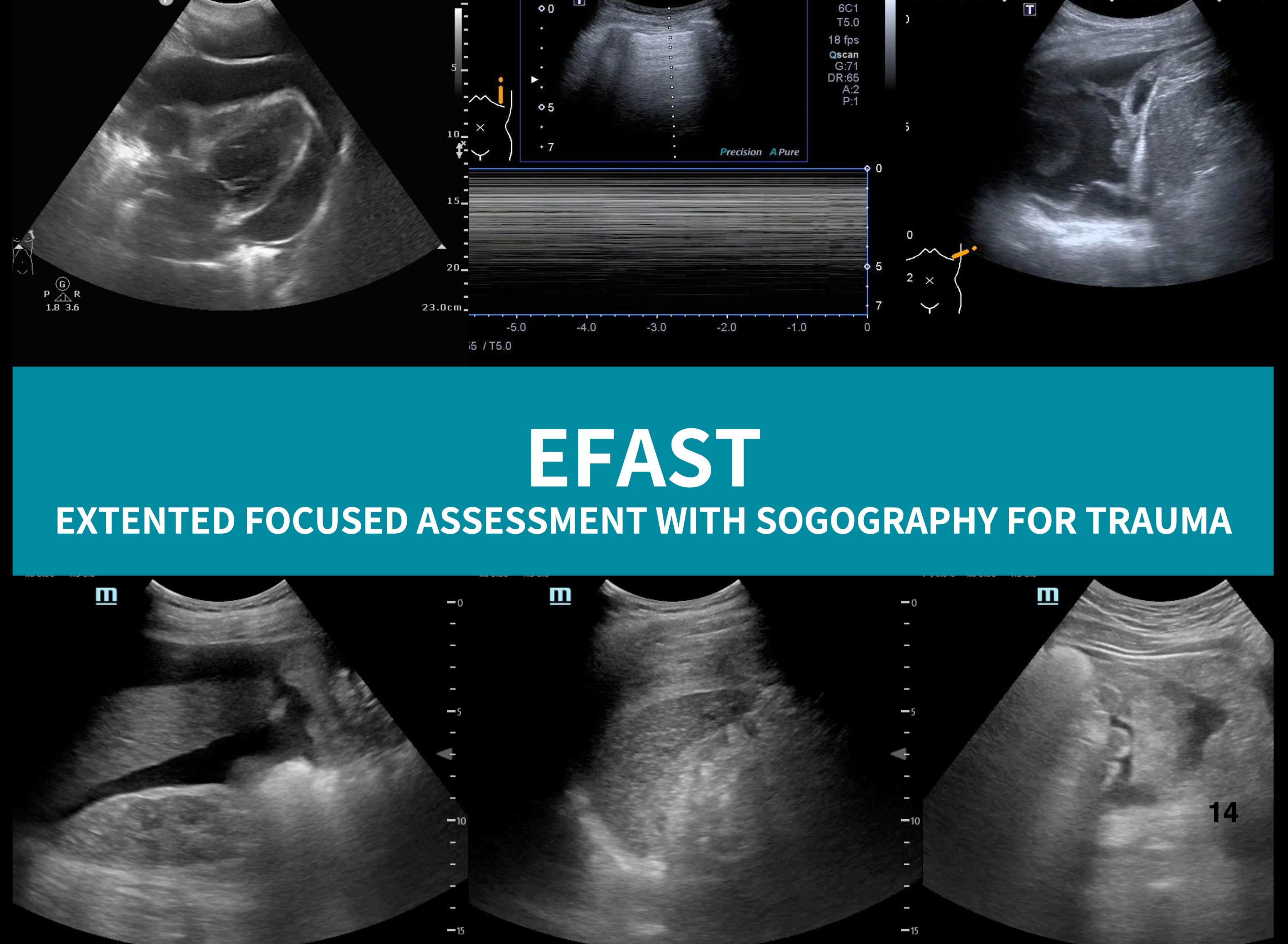 雙和急診超音波教學-EFAST – POCUS Academy