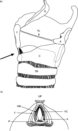 Laryngeal edema – POCUS Academy